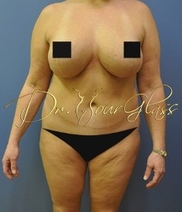 hourglass-tum-tuck-revision-dr-hourglass-wilberto-cortes-27007-34