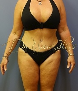 hourglass-tum-tuck-revision-dr-hourglass-wilberto-cortes-27007-36