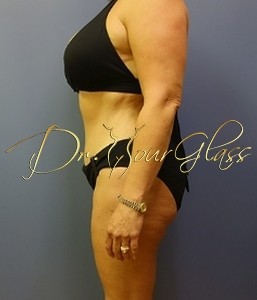 hourglass-tum-tuck-revision-dr-hourglass-wilberto-cortes-27007-38